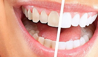 Бели зъби с почистване на зъбен камък с ултразвук с апаратно полиране само за 20 лв. вместо 80 лв. със 75% отстъпка от д-р Ваня Николова АИПИПДП!