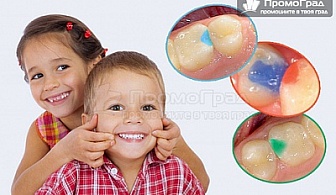 Детска пломба със специални цветни ефекти в 7 цвята, отделящи флуорни йони от Сити Дент